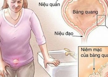 Viêm bàng quang rất dễ gặp phải, gây ảnh hưởng tới sức khỏe