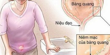 Viêm bàng quang rất dễ gặp phải, gây ảnh hưởng tới sức khỏe