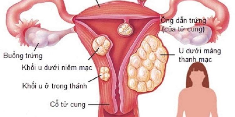 Đau bụng kinh là một tình trạng thường gặp khi đến kỳ kinh nguyệt