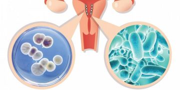 Nguyên nhân gây bệnh huyết trắng chủ yếu