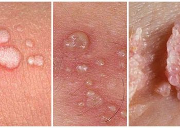 Sùi mào gà còn được gọi với cái tên khác là bệnh mồng gà 