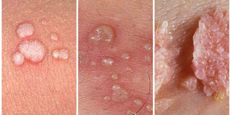 Sùi mào gà còn được gọi với cái tên khác là bệnh mồng gà 