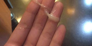 Cách chữa tinh trùng màu vàng bằng thuốc Đông y