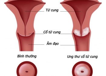 Ung thư cổ tử cung là một bệnh cực kỳ nguy hiểm