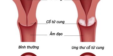 Ung thư cổ tử cung là một bệnh cực kỳ nguy hiểm