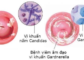 Nhiều nguyên nhân gây bệnh viêm âm đạo cần biết để điều trị 