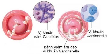 Nhiều nguyên nhân gây bệnh viêm âm đạo cần biết để điều trị 