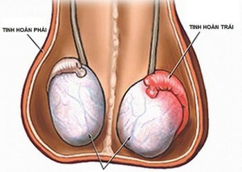  Viêm tinh hoàn là loại bệnh lý gì bạn đã biết? 