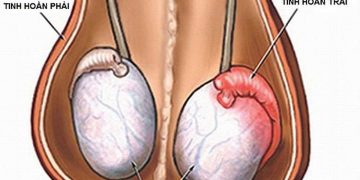 Viêm tinh hoàn là loại bệnh lý gì bạn đã biết? 