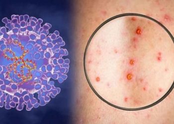 Đậu mùa khỉ là bệnh do một loại virus gần giống với bệnh đậu mùa gây ra