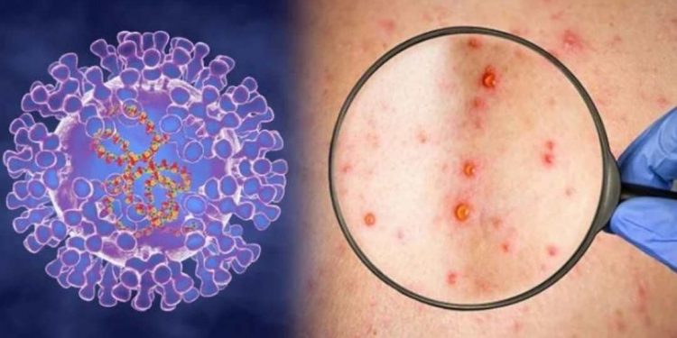 Đậu mùa khỉ là bệnh do một loại virus gần giống với bệnh đậu mùa gây ra