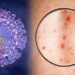 Đậu mùa khỉ là bệnh do một loại virus gần giống với bệnh đậu mùa gây ra