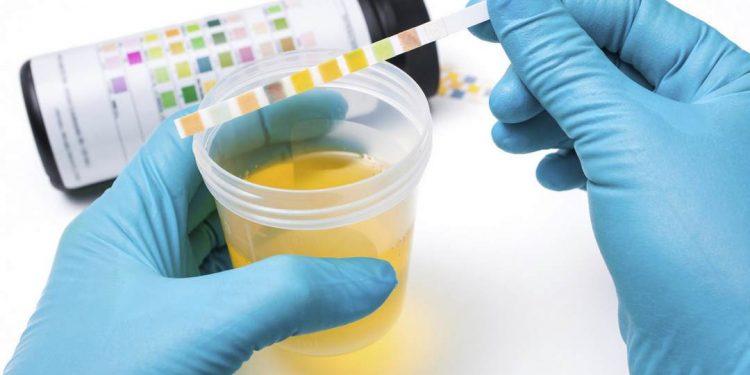 Nước tiểu màu vàng có ảnh hưởng tới sức khỏe như nào?
