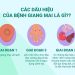 Mỗi giai đoạn mắc bệnh sẽ có những triệu chứng và dấu hiệu khác