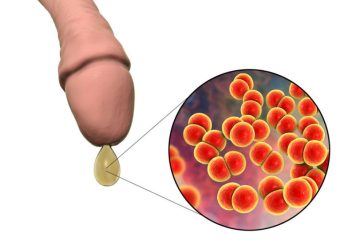 Ở nam, nữ giới khi mắc bệnh lậu xuất hiện những triệu chứng gì? 