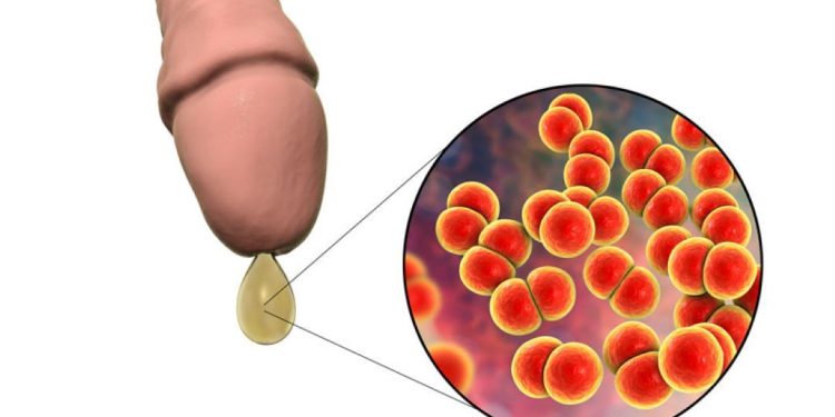 Ở nam, nữ giới khi mắc bệnh lậu xuất hiện những triệu chứng gì? 