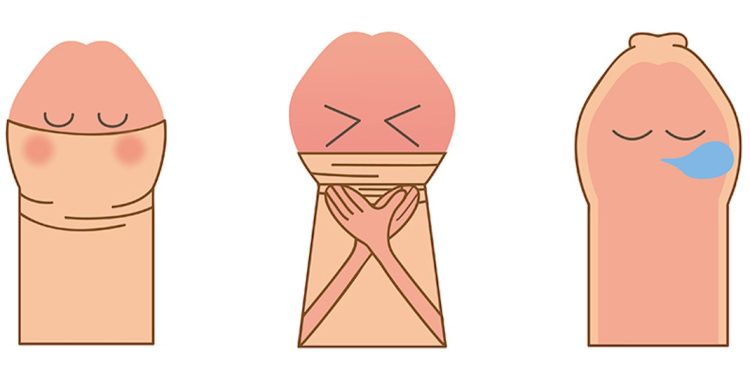Một số tình trạng của bao quy đầu mọi người cần biết