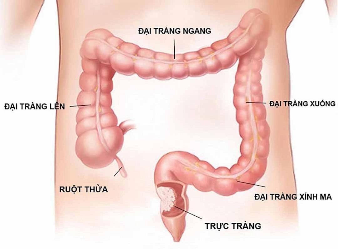 Đau bụng bên trái - dấu hiệu cảnh báo bệnh viêm loét dạ dày, trực tràng