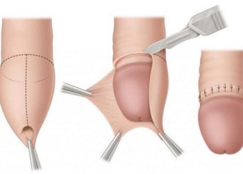 Hẹp bao quy đầu thường gặp ở trẻ nhỏ và nam giới trưởng thành