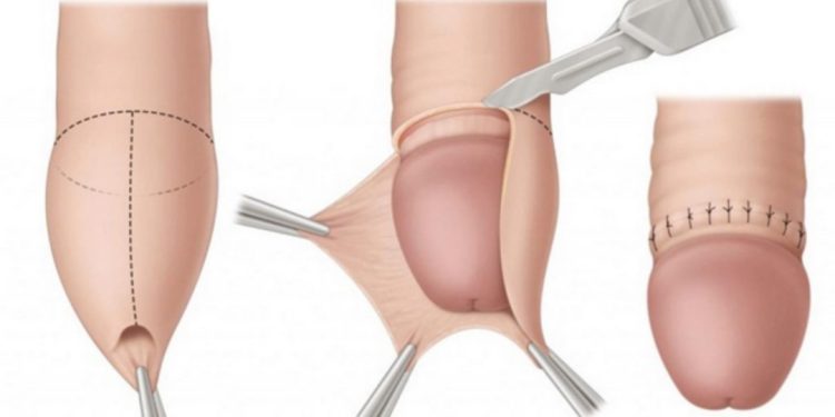 Hẹp bao quy đầu thường gặp ở trẻ nhỏ và nam giới trưởng thành