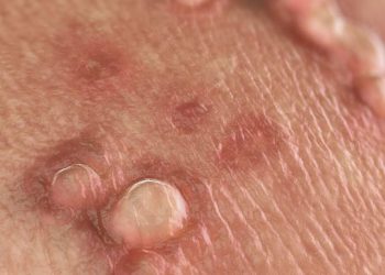 Mụn sinh dục là gì?