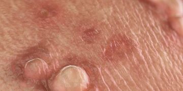 Mụn sinh dục là gì?