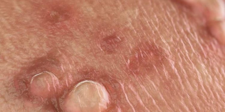 Mụn sinh dục là gì?