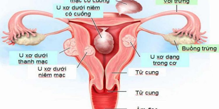 Nhân xơ tử cung được biết đến với tên gọi là u xơ tử cung