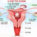 Nhân xơ tử cung được biết đến với tên gọi là u xơ tử cung