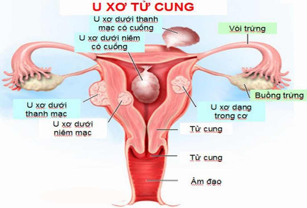 Nhân xơ tử cung được biết đến với tên gọi là u xơ tử cung