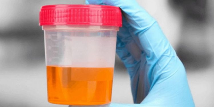 Khi cơ thể thiếu nước, mất nước dẫn tới nước tiểu có màu cam