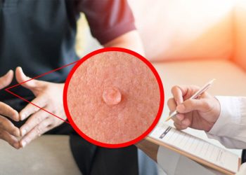 Bệnh sùi mào gà là một trong những bệnh xã hội thường gặp