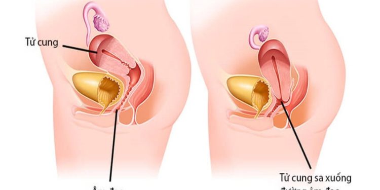 Hiện tượng về bệnh thường gặp ở phụ nữ sau sinh