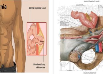 Định nghĩa về thoát vị bẹn