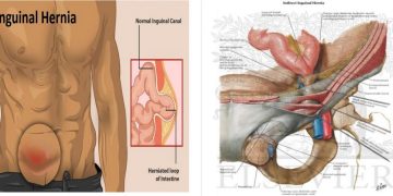 Định nghĩa về thoát vị bẹn