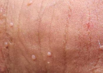 Sùi mào gà còn được gọi là bệnh mồng gà hoặc mụn cóc sinh dục