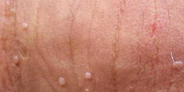 Sùi mào gà còn được gọi là bệnh mồng gà hoặc mụn cóc sinh dục