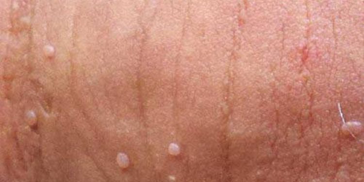 Sùi mào gà còn được gọi là bệnh mồng gà hoặc mụn cóc sinh dục