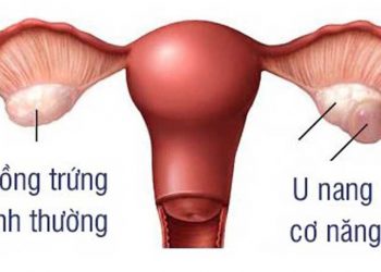 Hình ảnh U nang cơ năng