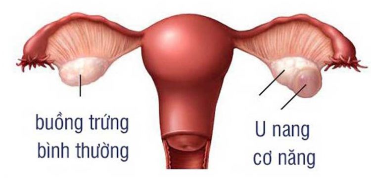 Hình ảnh U nang cơ năng