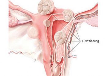 U xơ tử cung là bệnh lý lành tính xuất hiện ở đông đảo phụ nữ hiện nay 