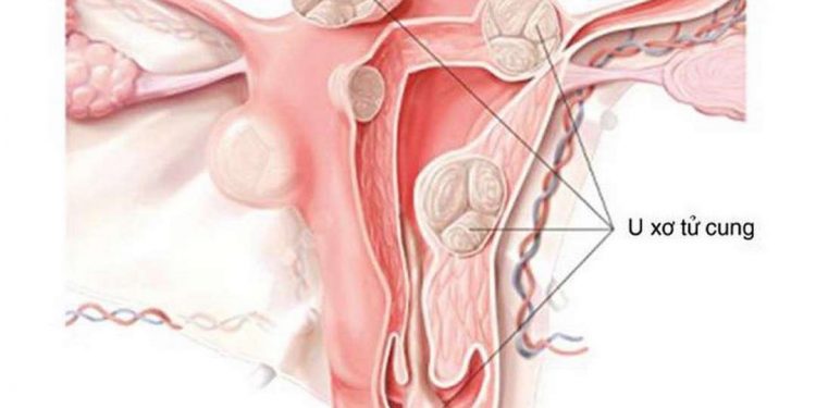 U xơ tử cung là bệnh lý lành tính xuất hiện ở đông đảo phụ nữ hiện nay 
