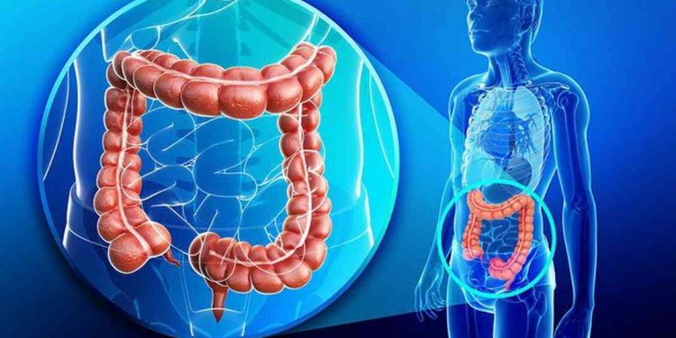 Ung thư trực tràng là tế bào ung thư khởi phát ở phần trực tràng