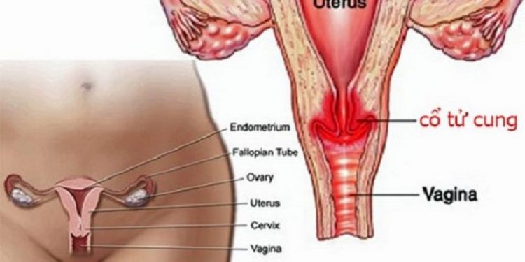 Viêm lộ tuyến cổ tử cung là bệnh phụ khoa của nữ giới