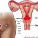 Viêm lộ tuyến cổ tử cung là bệnh phụ khoa của nữ giới