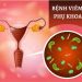 Viêm nhiễm phụ khoa là tình trạng bệnh lý khá phổ biến