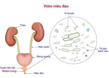 Viêm ở niệu đạo gây ra bởi nguyên nhân nào?