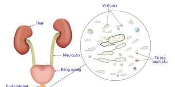 Viêm ở niệu đạo gây ra bởi nguyên nhân nào?
