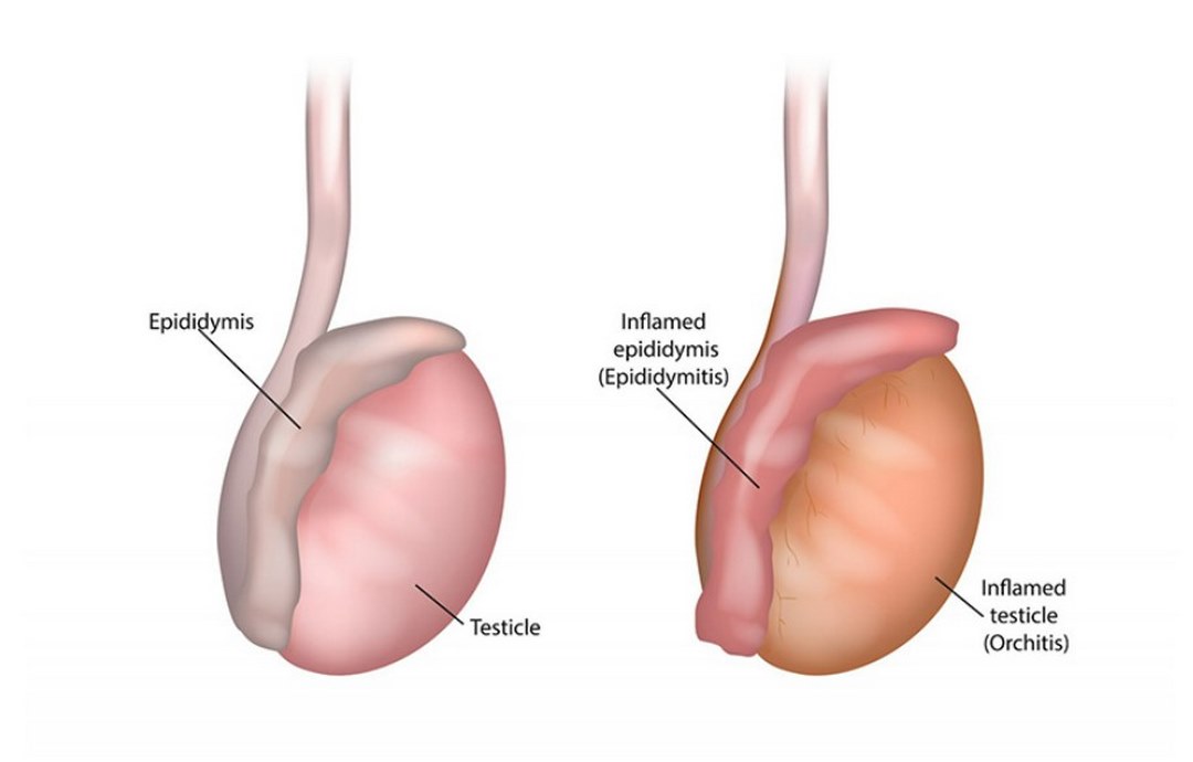 Khái quát về căn bệnh viêm tinh hoàn