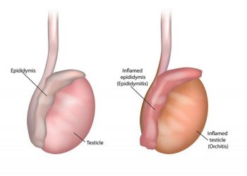 Điều trị viêm tinh hoàn bằng cách nào? Hiệu quả hay không?